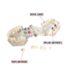 iDENTical Patient Education Model (Caries,implant,Nerves) M2001-3 Buy Dental products Online DentalMyntra