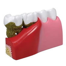 iDENTical Diseased Teeth and Gums Model M4029