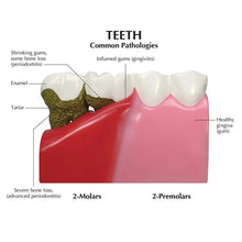 iDENTical Diseased Teeth and Gums Model M4029