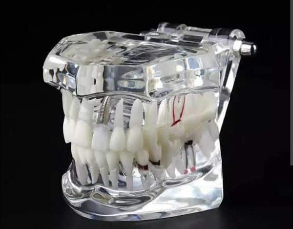 ALL IN ONE IMPLANT MODEL