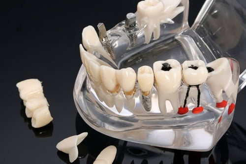 All-in-One Dental Implant Model – 3D Multifunctional