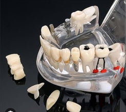 ALL IN ONE IMPLANT MODEL