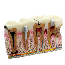 iDENTical Diseased Teeth and Gums Model M4029