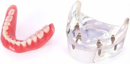 Over Denture Model