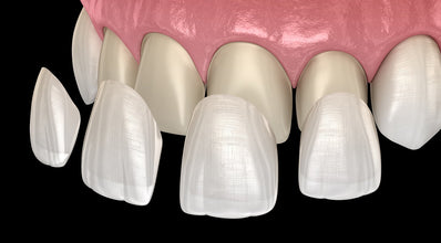Smart Dental Veneer Stick Set of 20 | Veneer Placement 