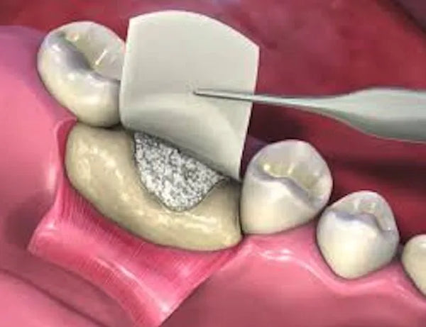 Xcem Osspore Collagen Membranes