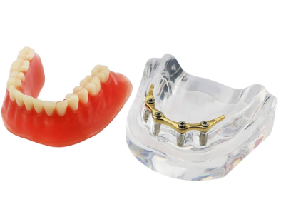 Implant Model with Bar – Dental Training Model