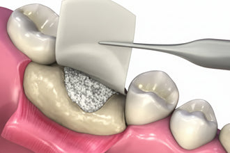 Xcem Osspore Collagen Membrane | Sterile Bone